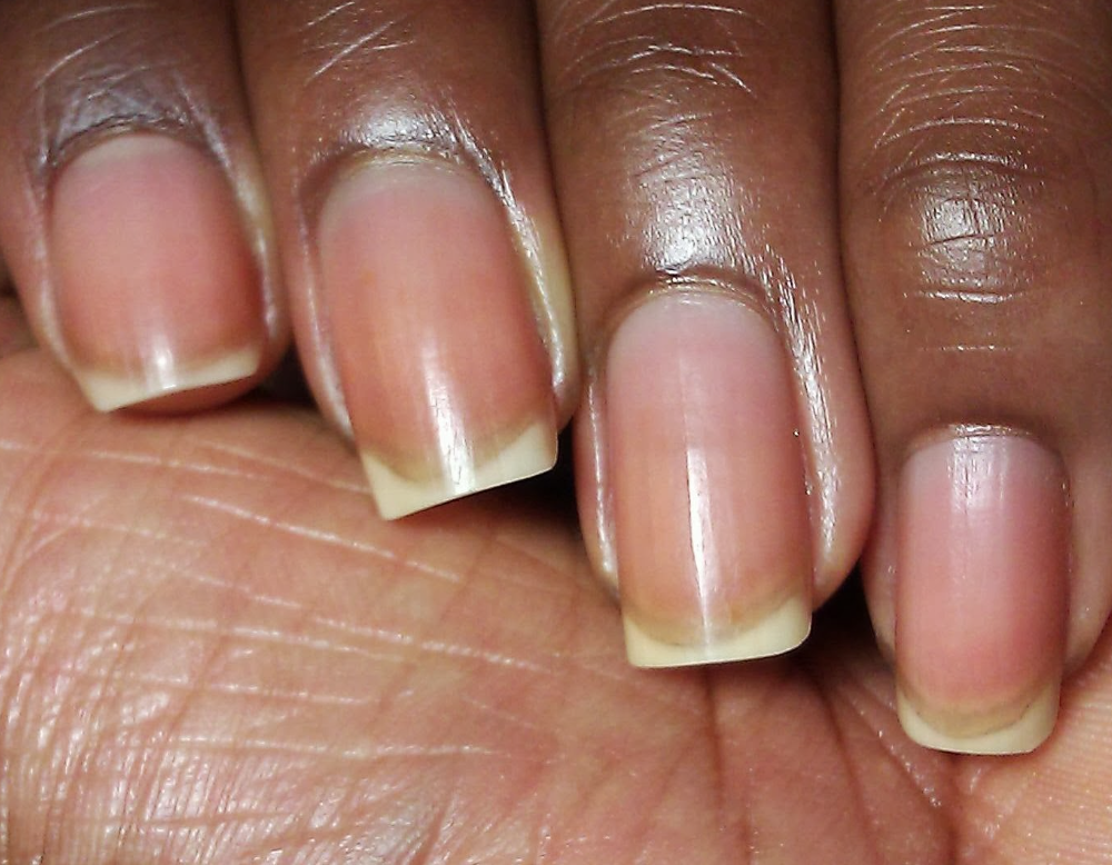 What you need to know about pseudomonas nail infections aka 